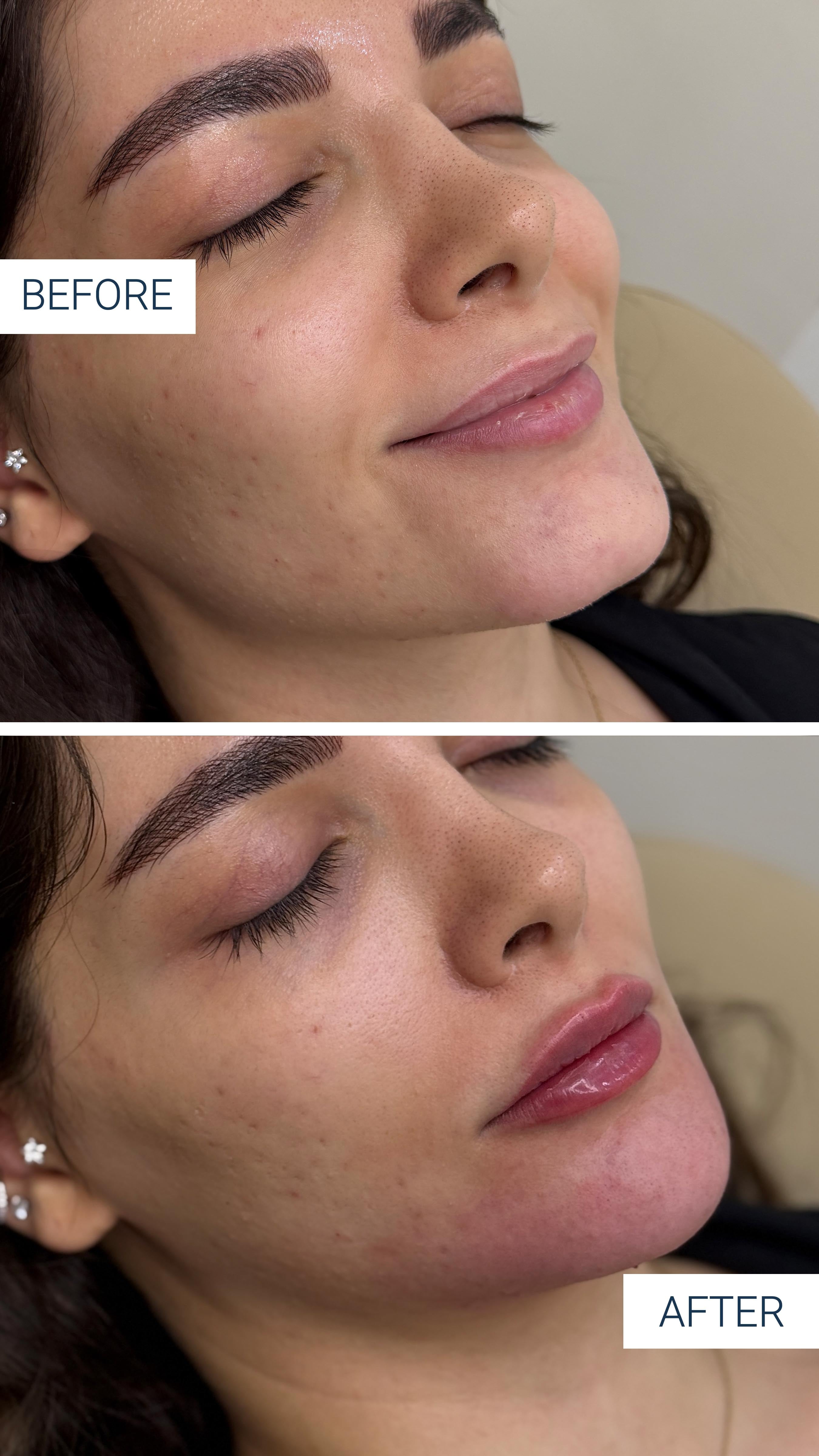 lipAndChinFiller before