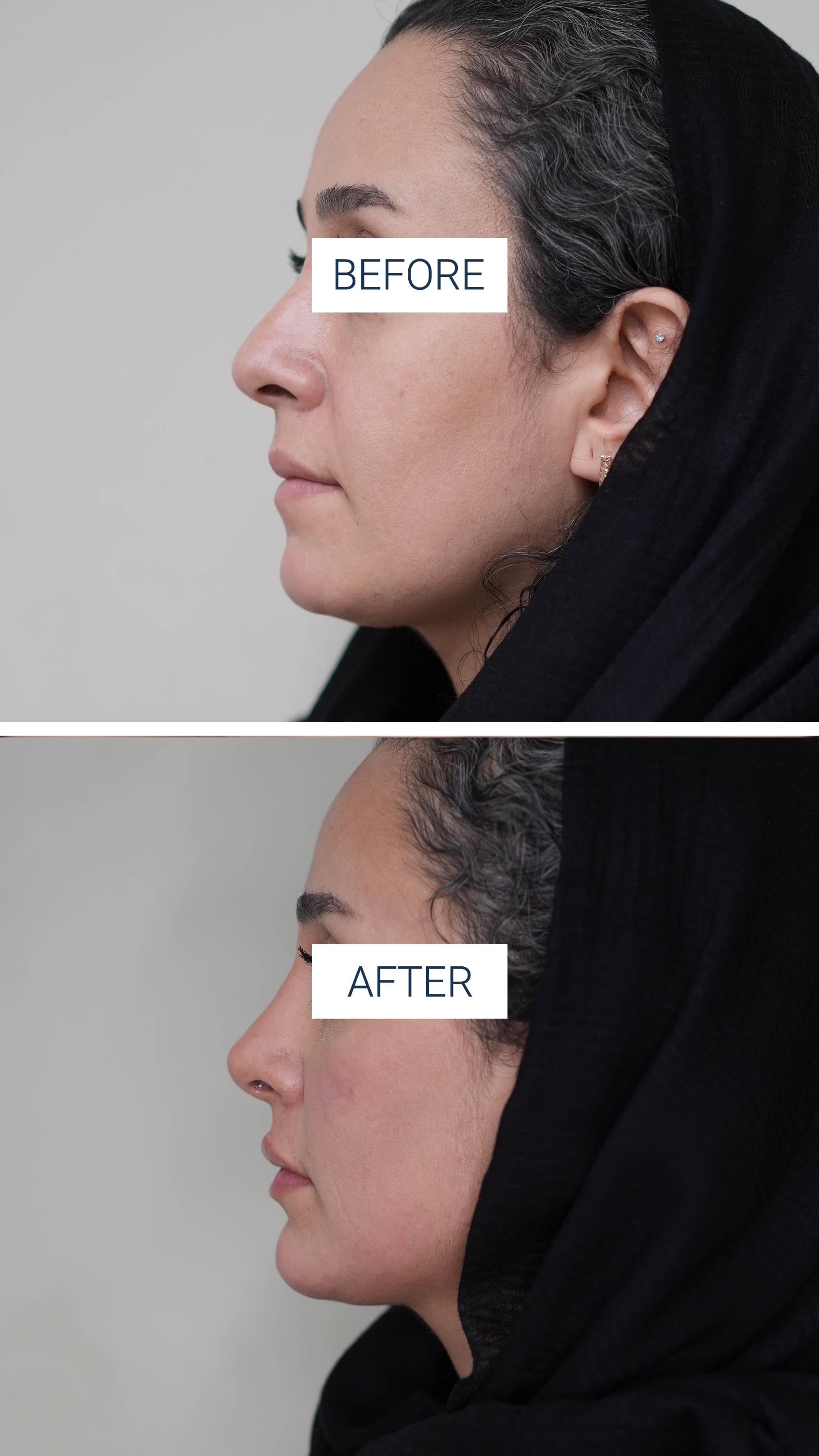 faceContouringAndNoseFiller before