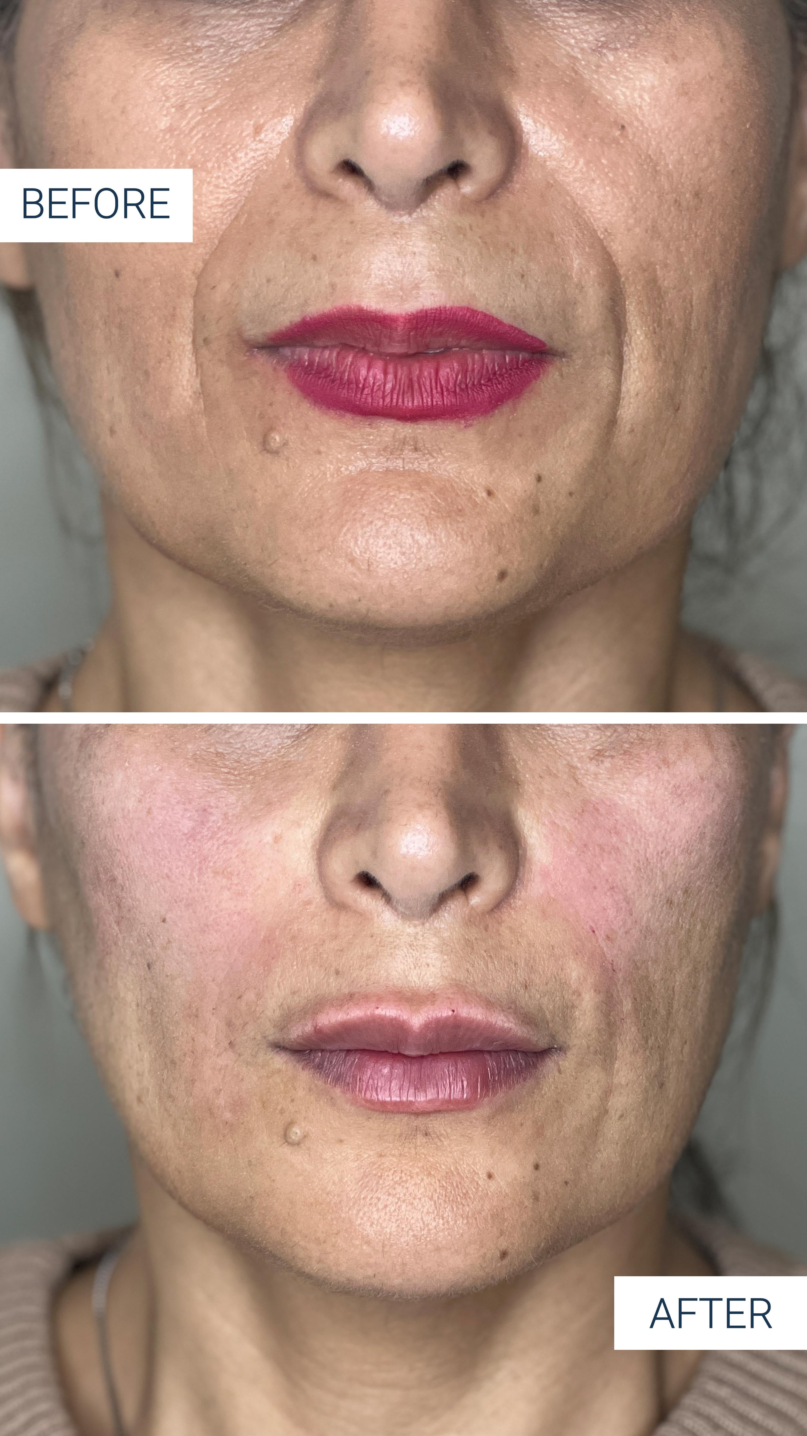 nasolabialFoldAndCheekFiller before